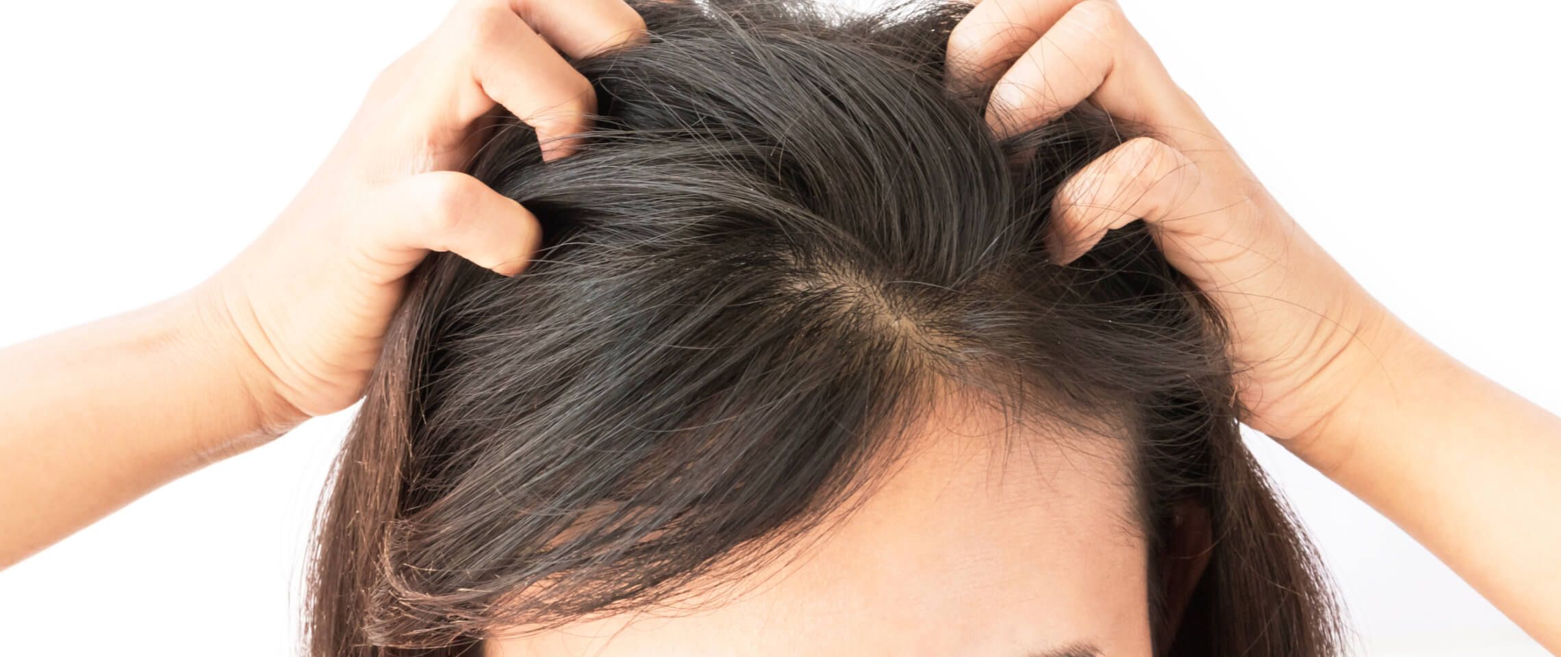 Control Dandruff Naturally