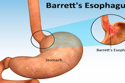 Barrett Esophagus
