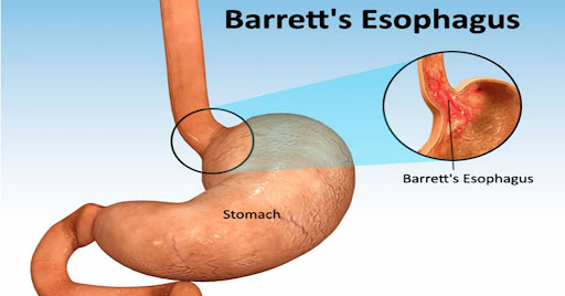 Barrett Esophagus