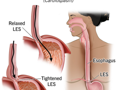 Achalasia: When Swallowing Stops Working Properly (And What You Can Do About It)