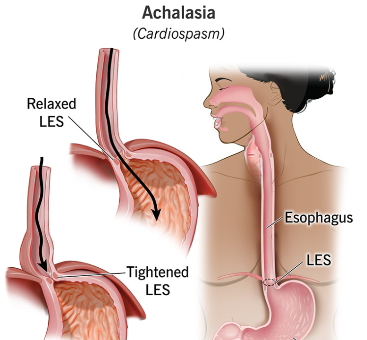 Achalasia: When Swallowing Stops Working Properly (And What You Can Do About It)