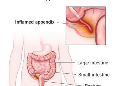 Appendicitis: A “Small” Organ That Can Turn Into a Big Emergency