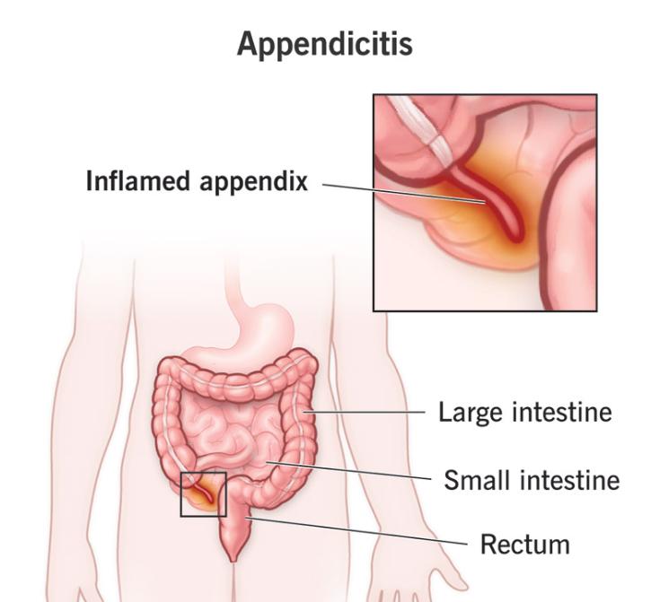 Appendicitis: A “Small” Organ That Can Turn Into a Big Emergency